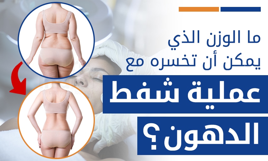 هل شفط الدهون ينقص الوزن ؟ كل مايتعلق عملية شفط الدهون ونقص الوزن